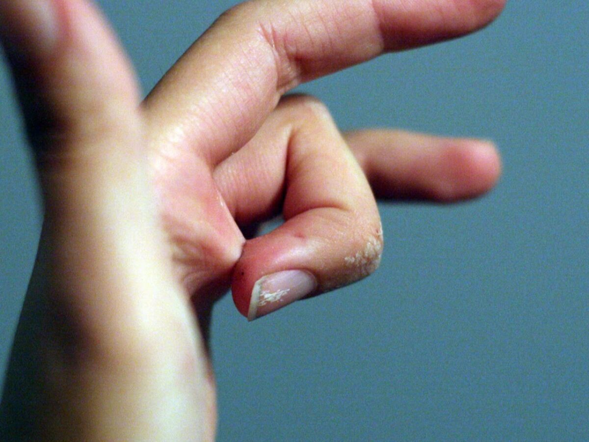 Склеенные пальцы суперклей